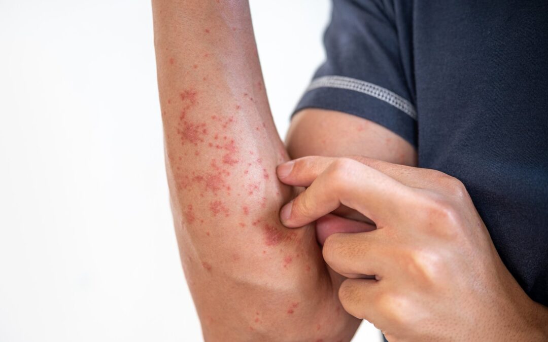 Lichen Planus