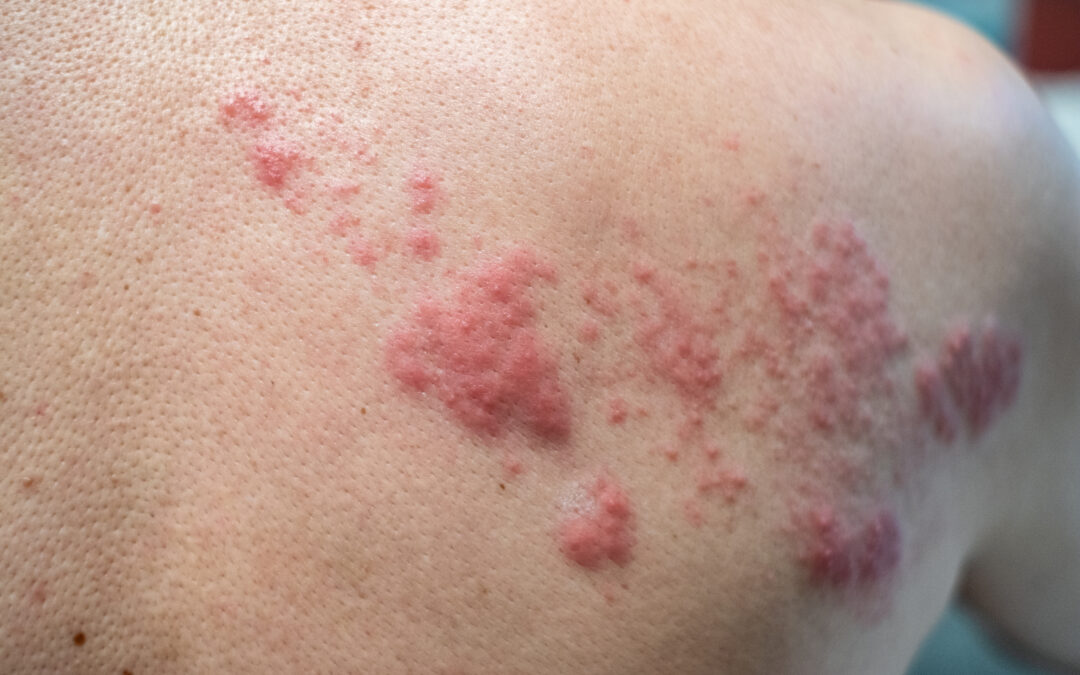 Lupus Rash