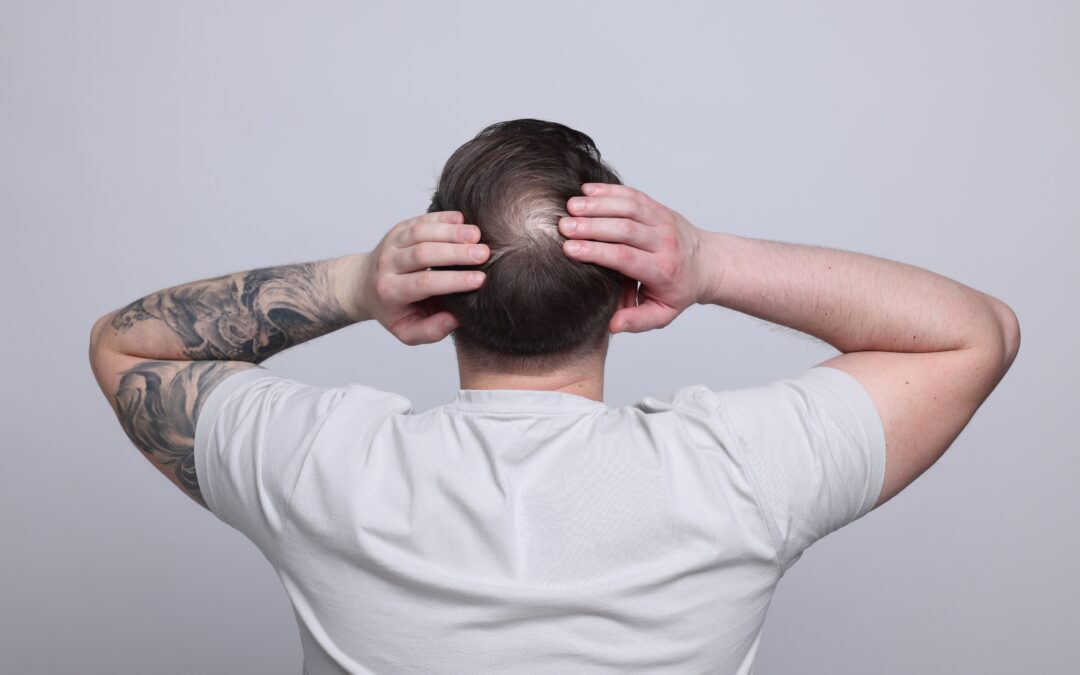 Male Pattern Baldness