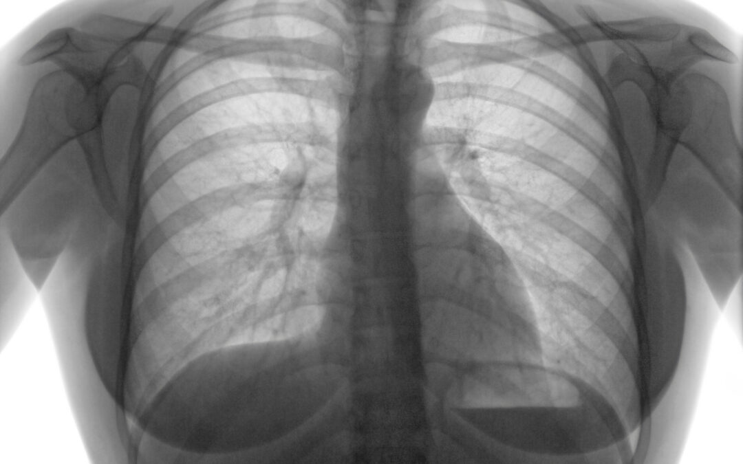 Sarcoidosis