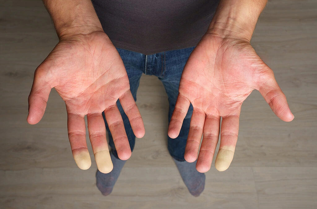 Scleroderma