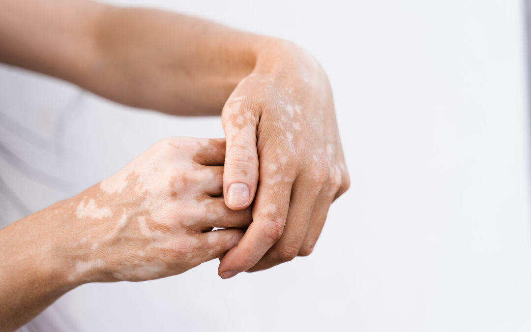 Vitiligo